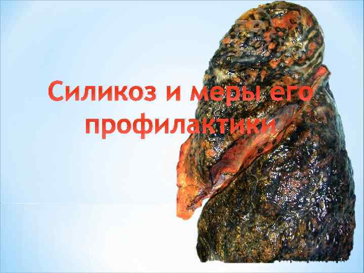 Силикоз и меры его профилактики 