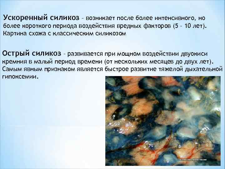 Ускоренный силикоз – возникает после более интенсивного, но более короткого периода воздействия вредных факторов