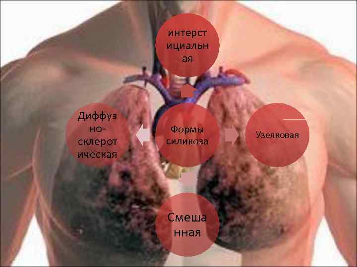 интерст ициальн ая Диффуз носклерот ическая Формы силикоза Смеша нная Узелковая 