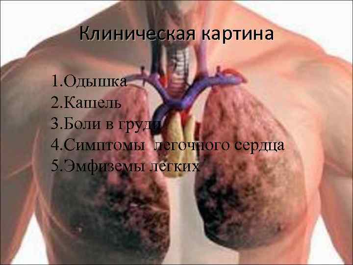 Клиническая картина 1. Одышка 2. Кашель 3. Боли в груди 4. Симптомы легочного сердца