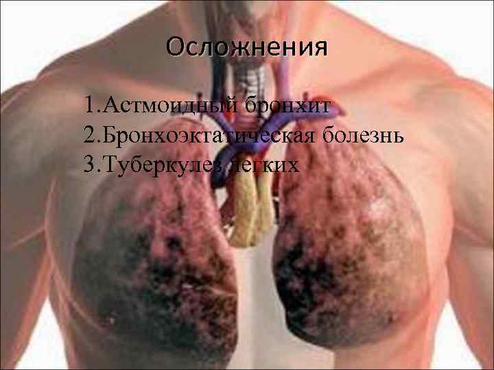 Осложнения 1. Астмоидный бронхит 2. Бронхоэктатическая болезнь 3. Туберкулез легких 
