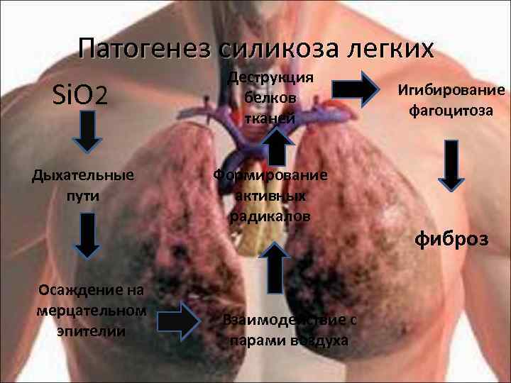 Силикоз план обследования