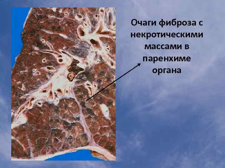 Очаги фиброза с некротическими массами в паренхиме органа 