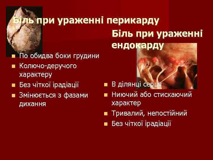 Біль при ураженні перикарду Біль при ураженні ендокарду По обидва боки грудини Колючо-деручого характеру