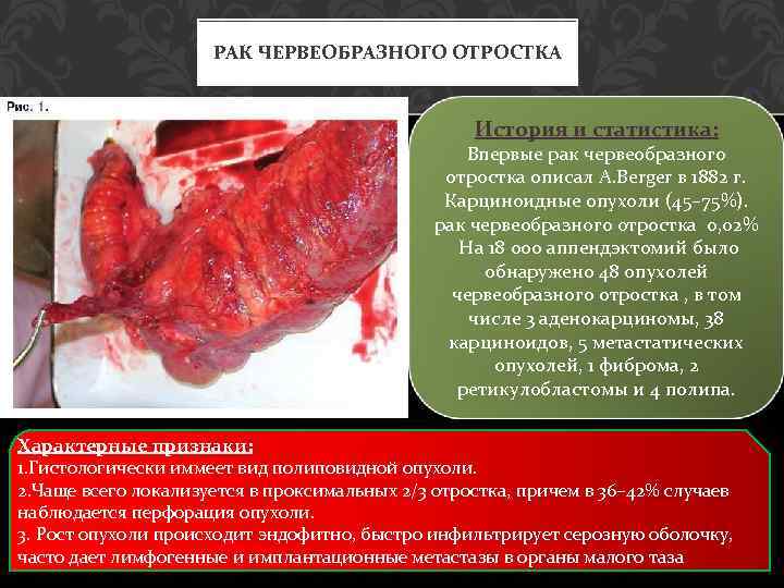 РАК ЧЕРВЕОБРАЗНОГО ОТРОСТКА История и статистика: Впервые рак червеобразного отростка описал A. Berger в