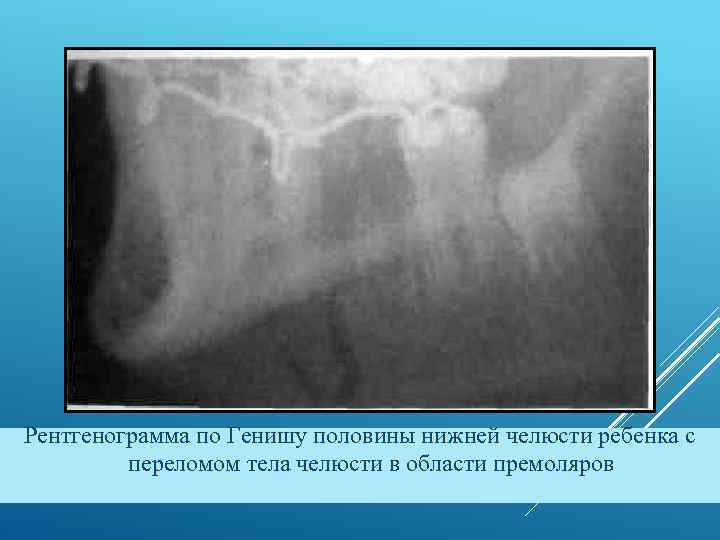 Рентгенограмма по Генишу половины нижней челюсти ребенка с переломом тела челюсти в области премоляров