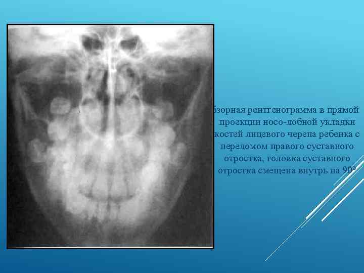 Обзорная рентгенограмма в прямой проекции носо лобной укладки костей лицевого черепа ребенка с переломом