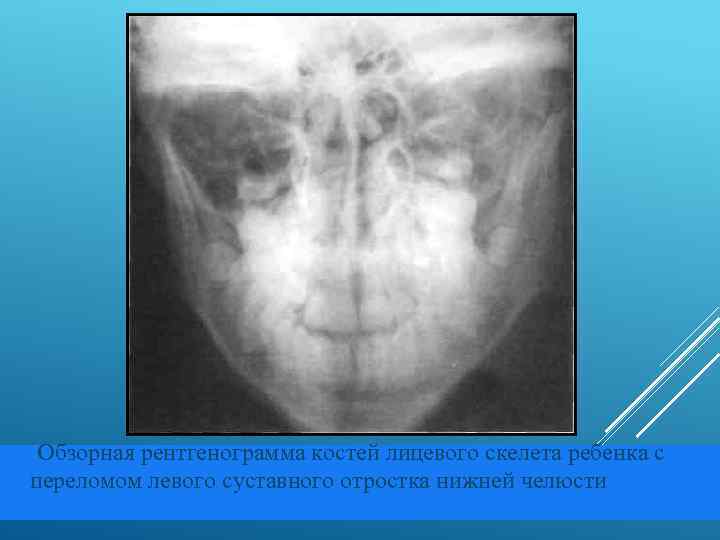  Обзорная рентгенограмма костей лицевого скелета ребенка с переломом левого суставного отростка нижней челюсти