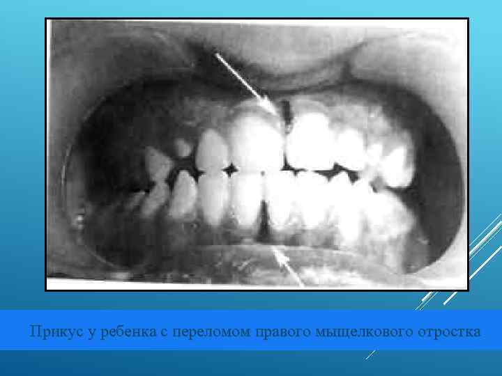  Прикус у ребенка с переломом правого мыщелкового отростка 