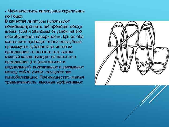  Межчелюстное лигатурное скрепление по Гоцко. В качестве лигатуры используют полиамидную нить. Её проводят