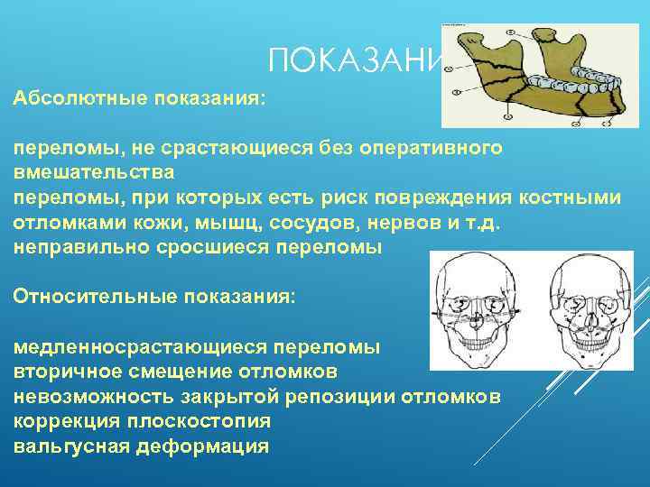 ПОКАЗАНИЯ: Абсолютные показания: переломы, не срастающиеся без оперативного вмешательства переломы, при которых есть риск