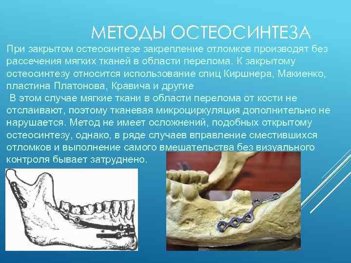 МЕТОДЫ ОСТЕОСИНТЕЗА При закрытом остеосинтезе закрепление отломков производят без рассечения мягких тканей в области