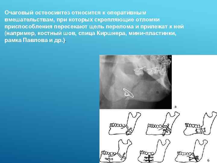 Очаговый остеосинтез относится к оперативным вмешательствам, при которых скрепляющие отломки приспособления пересекают щель перелома