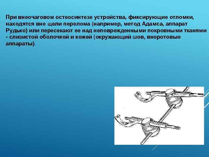 При внеочаговом остеосинтезе устройства, фиксирующие отломки, находятся вне щели перелома (например, метод Адамса, аппарат