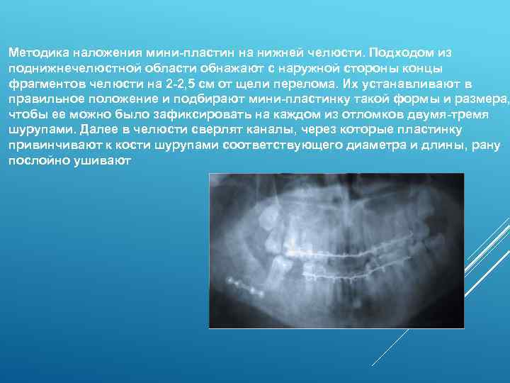 Методика наложения мини-пластин на нижней челюсти. Подходом из поднижнечелюстной области обнажают с наружной стороны