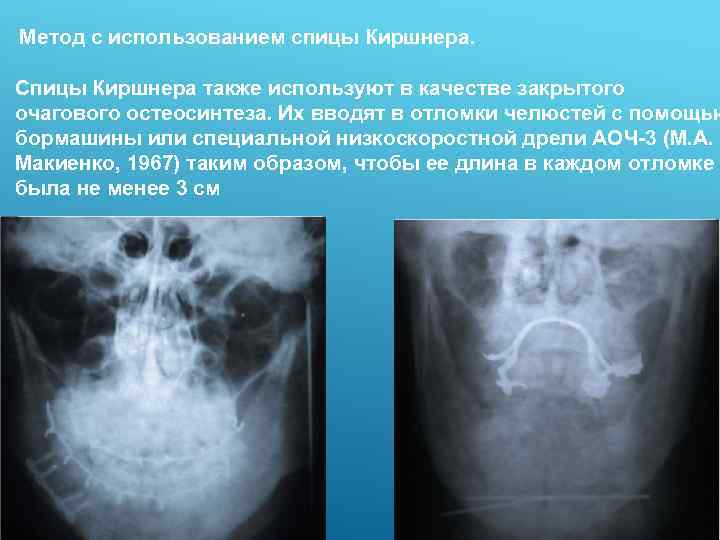  Метод с использованием спицы Киршнера. Спицы Киршнера также используют в качестве закрытого очагового