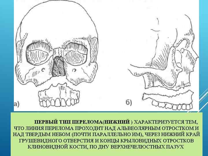  ПЕРВЫЙ ТИП ПЕРЕЛОМА(НИЖНИЙ ) ХАРАКТЕРИЗУЕТСЯ ТЕМ, ЧТО ЛИНИЯ ПЕРЕЛОМА ПРОХОДИТ НАД АЛЬВЕОЛЯРНЫМ ОТРОСТКОМ