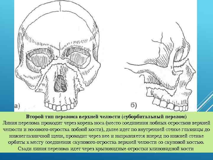 Второй тип перелома верхней челюсти (суборбитальный перелом) Линия перелома проходит через корень носа (место