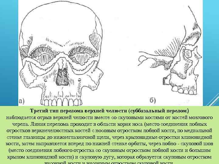 Третий тип перелома верхней челюсти (суббазальный перелом) наблюдается отрыв верхней челюсти вместе со скуловыми