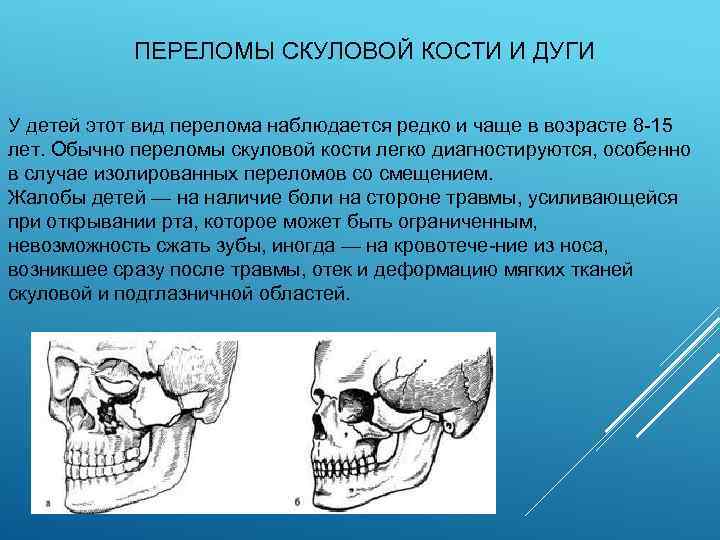  ПЕРЕЛОМЫ СКУЛОВОЙ КОСТИ И ДУГИ У детей этот вид перелома наблюдается редко и