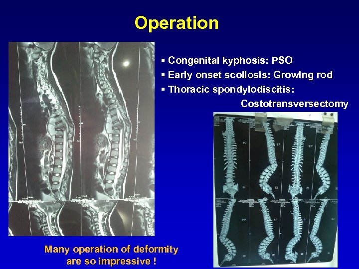 Operation § Congenital kyphosis: PSO § Early onset scoliosis: Growing rod § Thoracic spondylodiscitis: