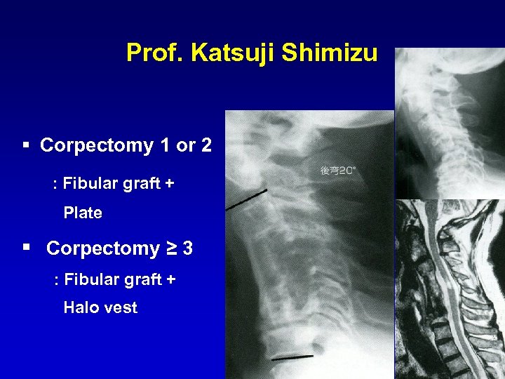 Prof. Katsuji Shimizu § Corpectomy 1 or 2 : Fibular graft + Plate §