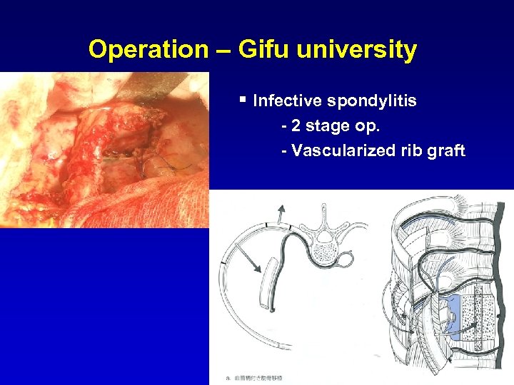 Operation – Gifu university § Infective spondylitis - 2 stage op. - Vascularized rib