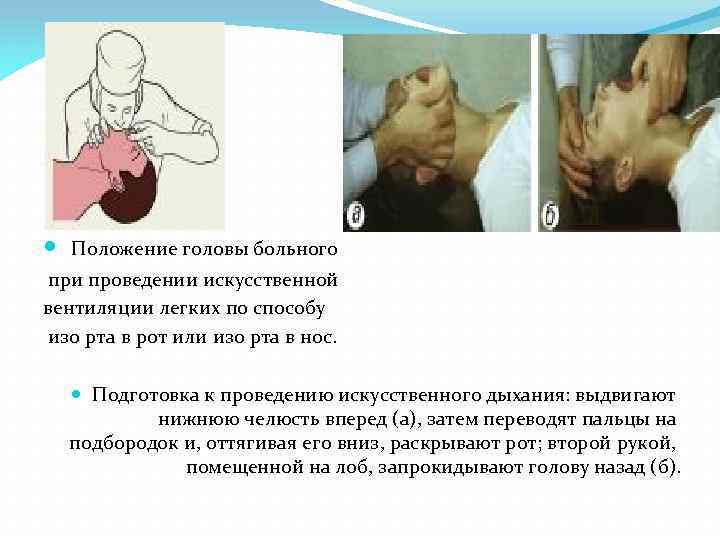  Положение головы больного при проведении искусственной вентиляции легких по способу изо рта в