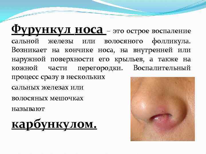 Фурункул носа – это острое воспаление сальной железы или волосяного фолликула. Возникает на кончике