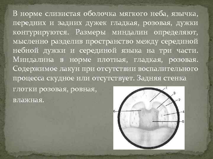 В норме слизистая оболочка мягкого неба, язычка, передних и задних дужек гладкая, розовая, дужки