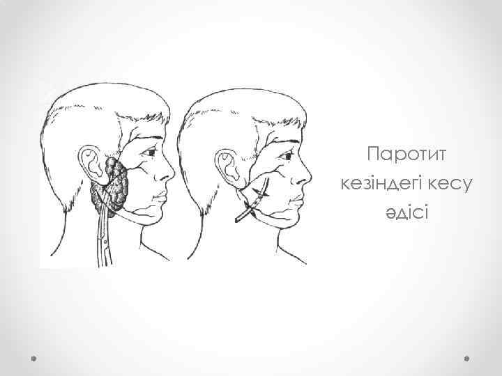 Паротит кезіндегі кесу әдісі 