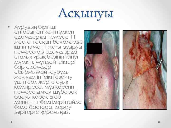 Асқынуы • Аурудың бірінші аптасынан кейін үлкен адамдарда немесе 11 жастан асқан балаларда іштің