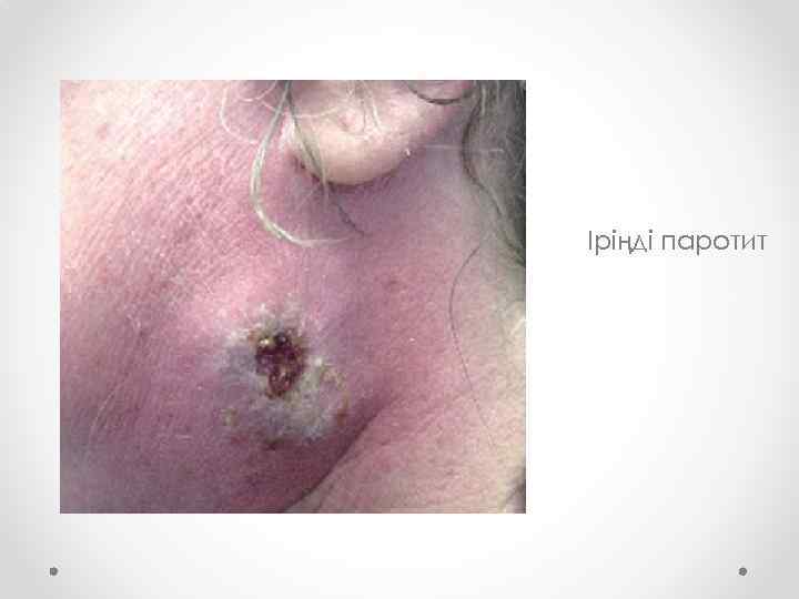 Іріңді паротит 