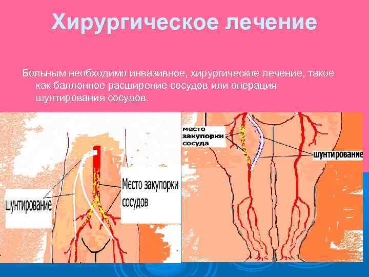 Хирургическое лечение Больным необходимо инвазивное, хирургическое лечение, такое как баллонное расширение сосудов или операция