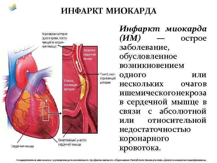 ИНФАРКТ МИОКАРДА Инфаркт миокарда (ИМ) — острое заболевание, обусловленное возникновением одного или нескольких очагов