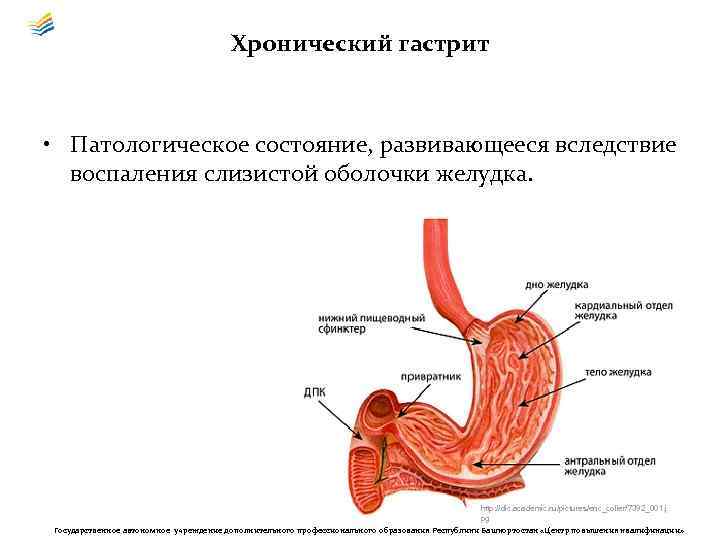 Хронический гастрит • Патологическое состояние, развивающееся вследствие воспаления слизистой оболочки желудка. http: //dic. academic.