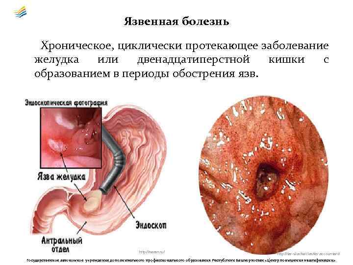 Язвенная болезнь Хроническое, циклически протекающее заболевание желудка или двенадцатиперстной кишки с образованием в периоды