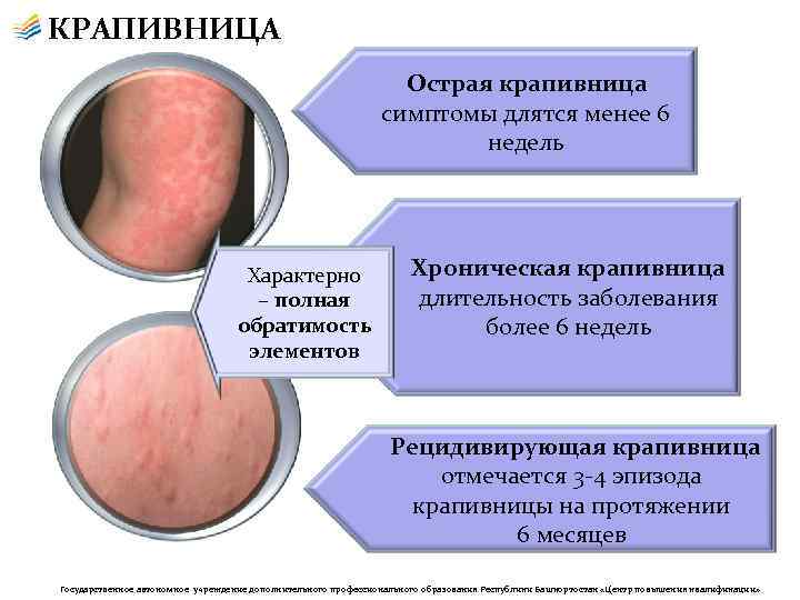 КРАПИВНИЦА Острая крапивница симптомы длятся менее 6 недель Характерно – полная обратимость элементов Хроническая