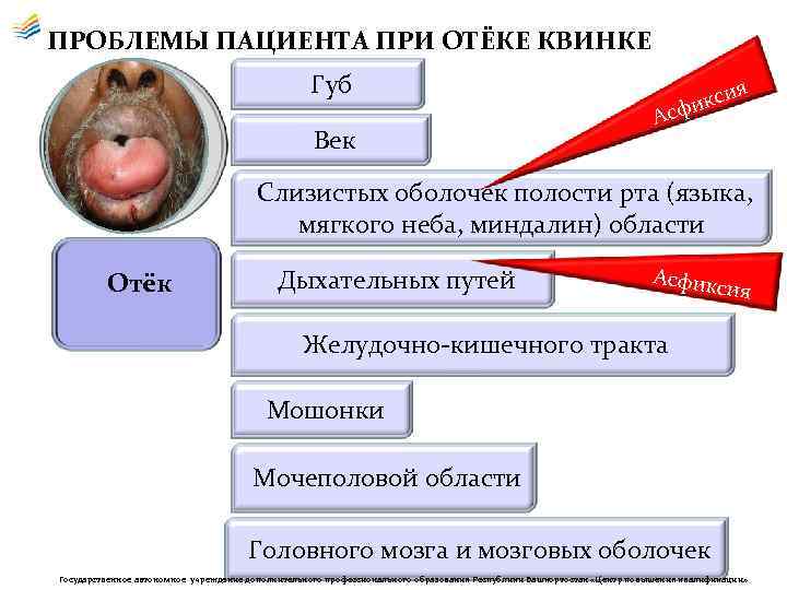 ПРОБЛЕМЫ ПАЦИЕНТА ПРИ ОТЁКЕ КВИНКЕ Губ Век ия с фик с А Слизистых оболочек