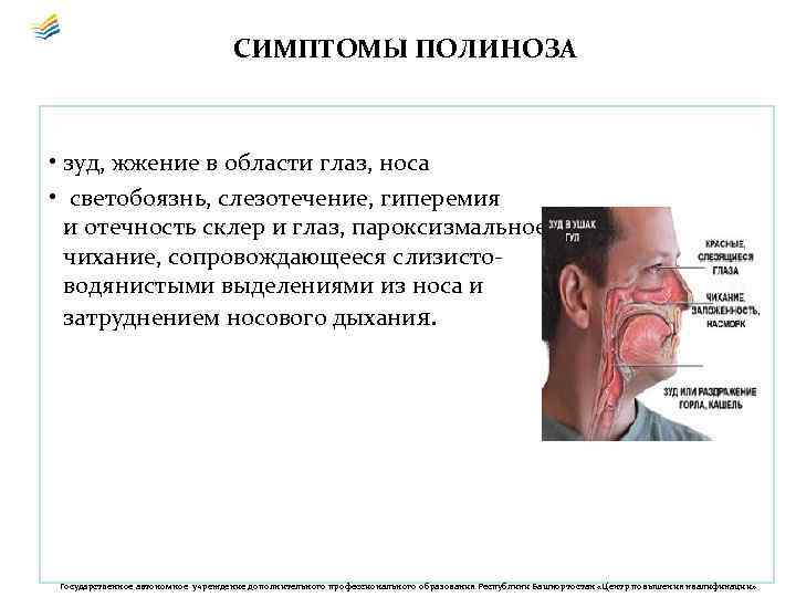 СИМПТОМЫ ПОЛИНОЗА • зуд, жжение в области глаз, носа • светобоязнь, слезотечение, гиперемия и