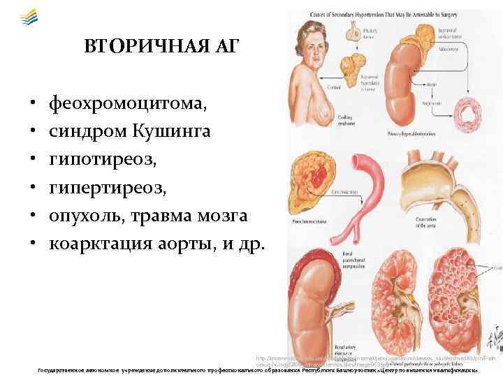 ВТОРИЧНАЯ АГ • • • феохромоцитома, синдром Кушинга гипотиреоз, гипертиреоз, опухоль, травма мозга коарктация