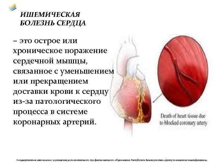 ИШЕМИЧЕСКАЯ БОЛЕЗНЬ СЕРДЦА – это острое или хроническое поражение сердечной мышцы, связанное с уменьшением