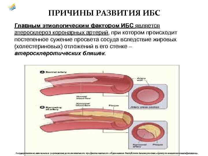 ПРИЧИНЫ РАЗВИТИЯ ИБС Главным этиологическим фактором ИБС является этиологическим фактором ИБС атеросклероз коронарных артерий,