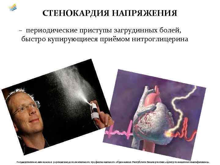 СТЕНОКАРДИЯ НАПРЯЖЕНИЯ – периодические приступы загрудинных болей, быстро купирующиеся приёмом нитроглицерина Государственное автономное учреждение