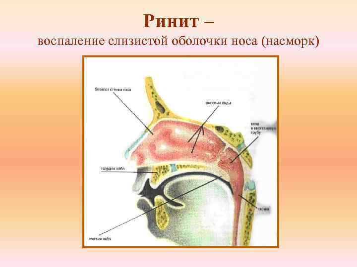 Ринит – воспаление слизистой оболочки носа (насморк) 