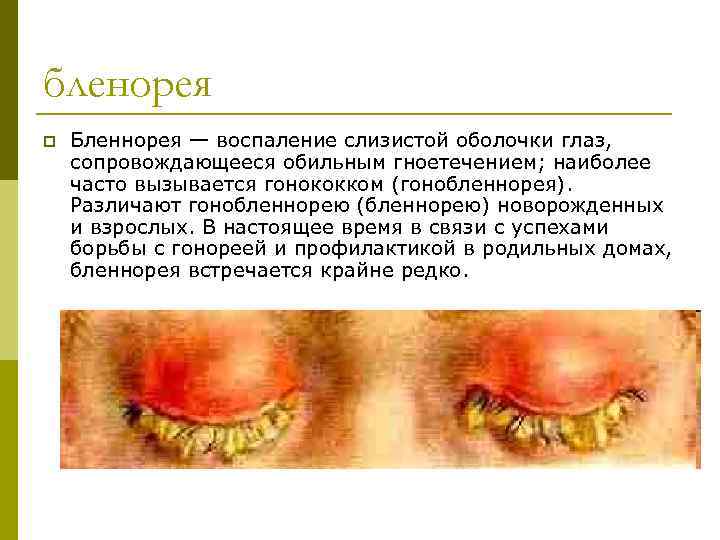 бленорея p Бленнорея — воспаление слизистой оболочки глаз, сопровождающееся обильным гноетечением; наиболее часто вызывается
