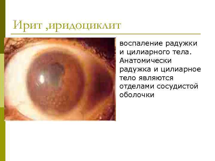 Ирит , иридоциклит p воспаление радужки и цилиарного тела. Анатомически радужка и цилиарное тело