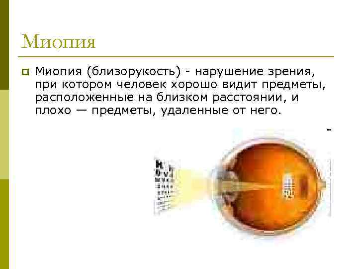 Миопия p Миопия (близорукость) - нарушение зрения, при котором человек хорошо видит предметы, расположенные