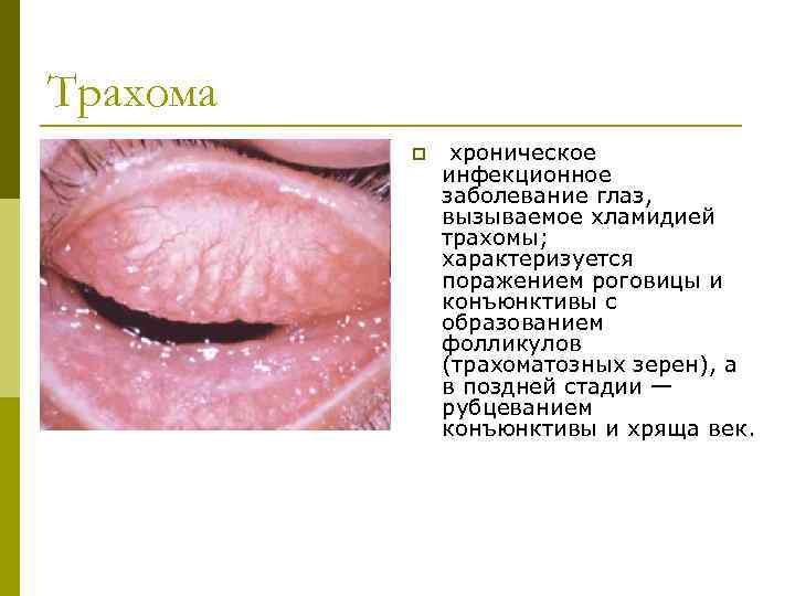 Трахома p хроническое инфекционное заболевание глаз, вызываемое хламидией трахомы; характеризуется поражением роговицы и конъюнктивы