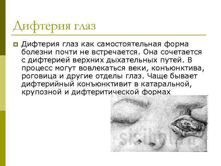 Дифтерия глаз p Дифтерия глаз как самостоятельная форма болезни почти не встречается. Она сочетается